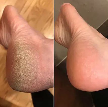 Dead Skin Callus Remover (Summer Sale)