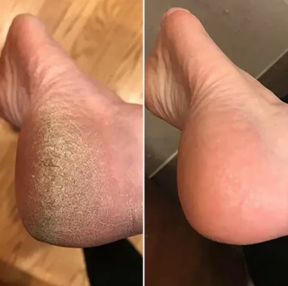 Dead Skin Callus Remover (Summer Sale)